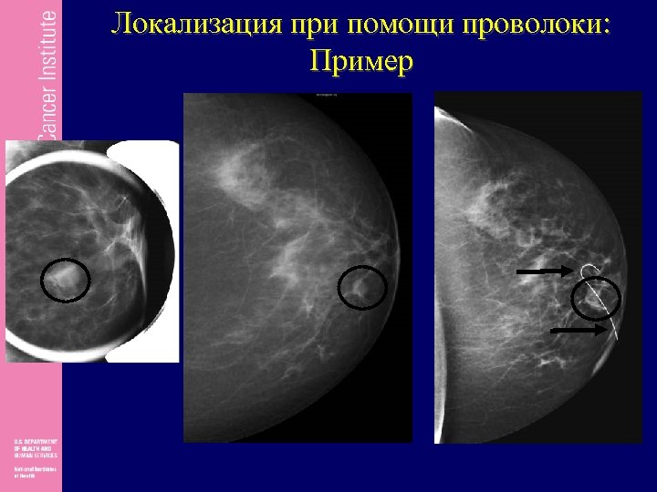 Локализация при помощи проволоки: Пример 