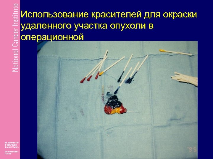 Использование красителей для окраски удаленного участка опухоли в операционной 