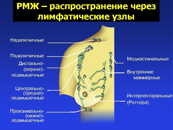 РМЖ – распространение через лимфатические узлы Надключичные Подключичные Дистально(верхне)подмышечные Центрально(средне)подмышечные Проксимально(нижне)подмышечные Медиастинальные Внутренние маммарные
