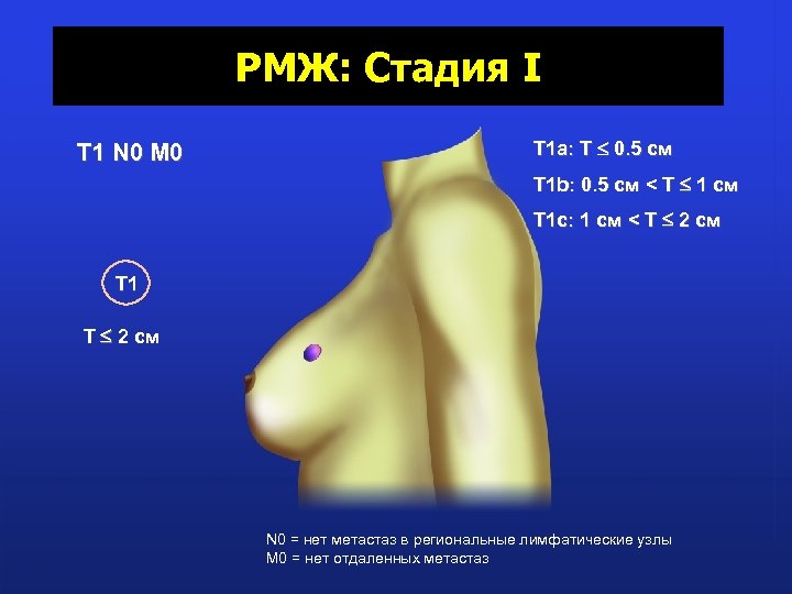 РМЖ: Стадия I T 1 N 0 M 0 T 1 a: T 0.