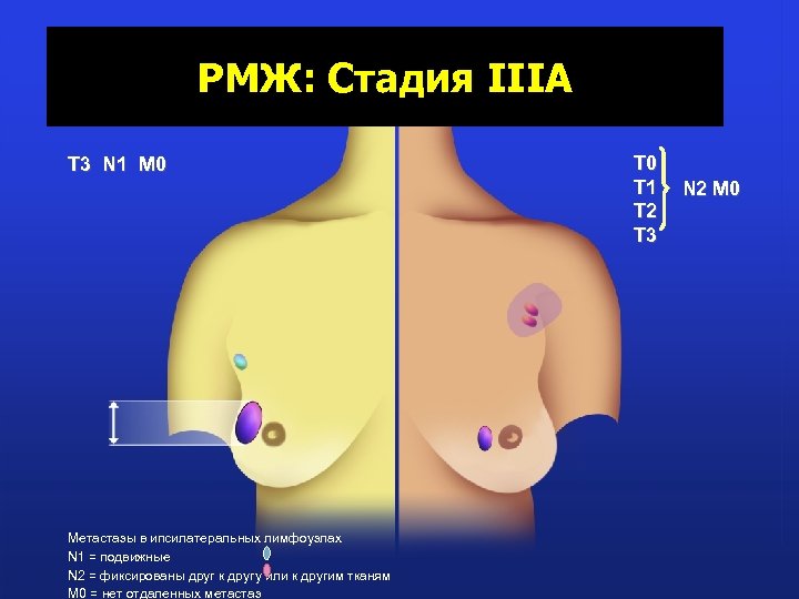 РМЖ: Стадия IIIA T 3 N 1 M 0 Метастазы в ипсилатеральных лимфоузлах N