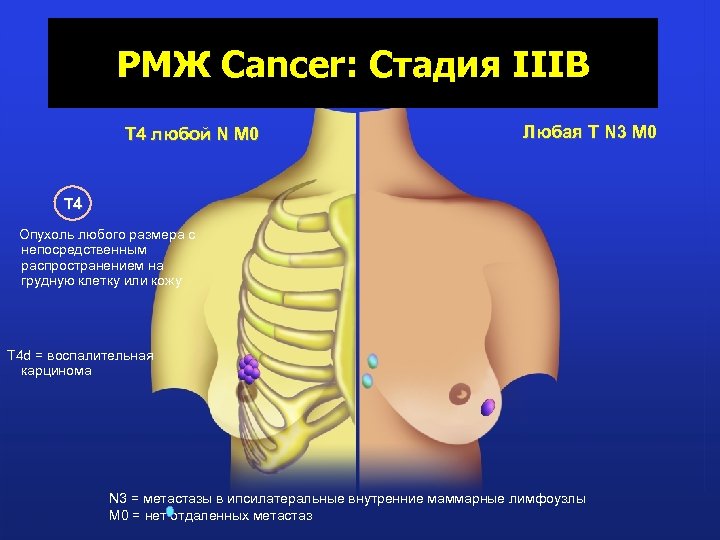 РМЖ Cancer: Стадия IIIB T 4 любой N M 0 Любая T N 3