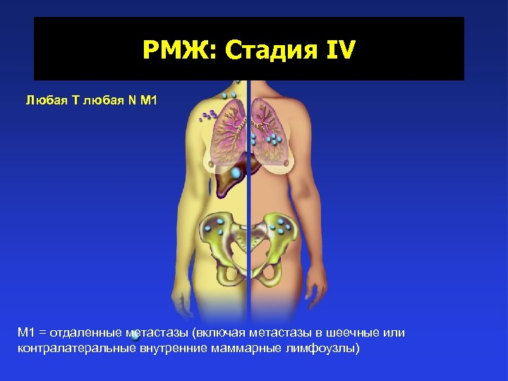 РМЖ: Стадия IV Любая T любая N M 1 = отдаленные метастазы (включая метастазы