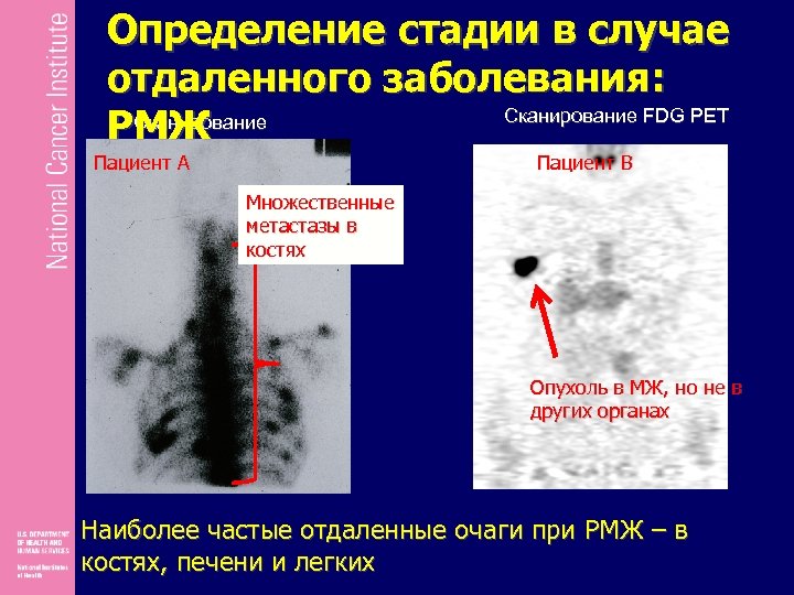 Определение стадии в случае отдаленного заболевания: Сканирование FDG PET Сканирование РМЖ костей Пациент A