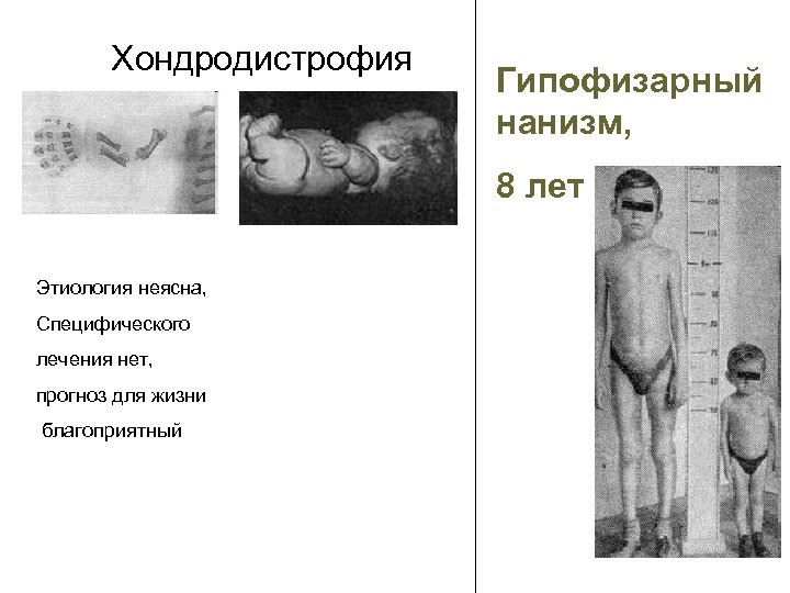 Хондродистрофия Гипофизарный нанизм, 8 лет Этиология неясна, Специфического лечения нет, прогноз для жизни благоприятный