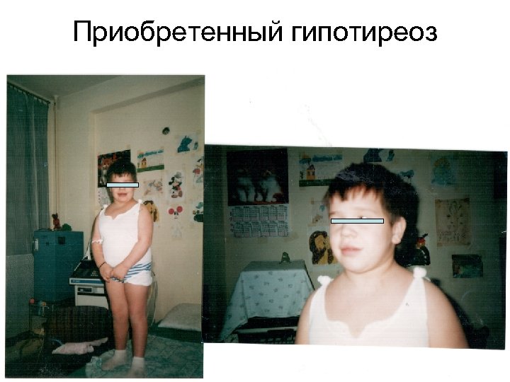 Приобретенный гипотиреоз 