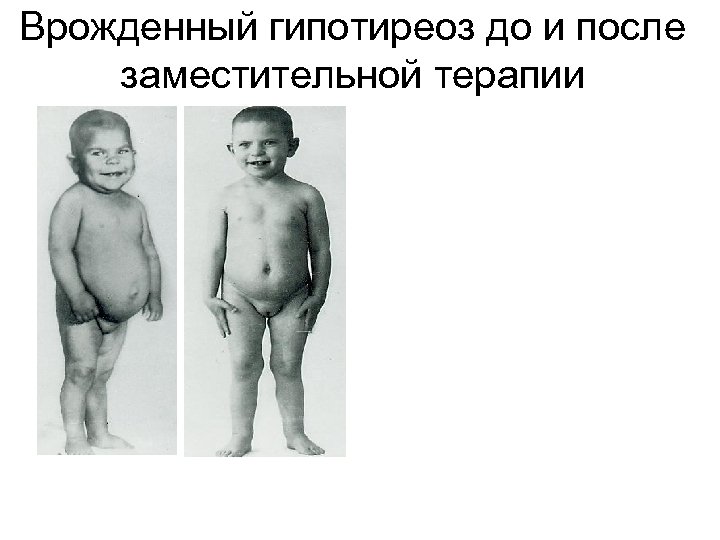 Врожденный гипотиреоз до и после заместительной терапии 