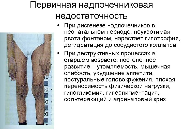 Первичная надпочечниковая недостаточность • При дисгенезе надпочечников в неонатальном периоде: неукротимая рвота фонтаном, нарастает