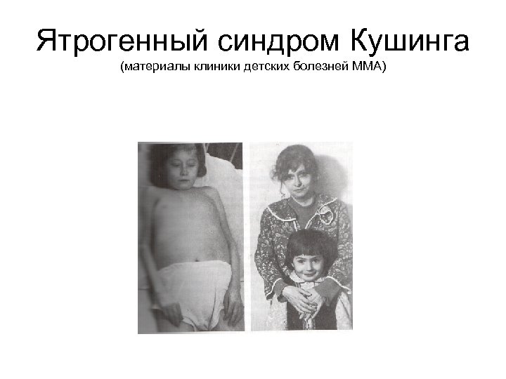 Ятрогенный синдром Кушинга (материалы клиники детских болезней ММА) 