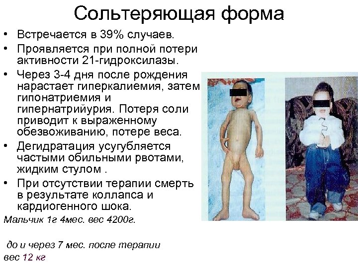 Сольтеряющая форма • Встречается в 39% случаев. • Проявляется при полной потери активности 21