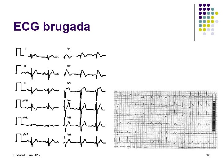 ECG brugada Updated June 2012 12 