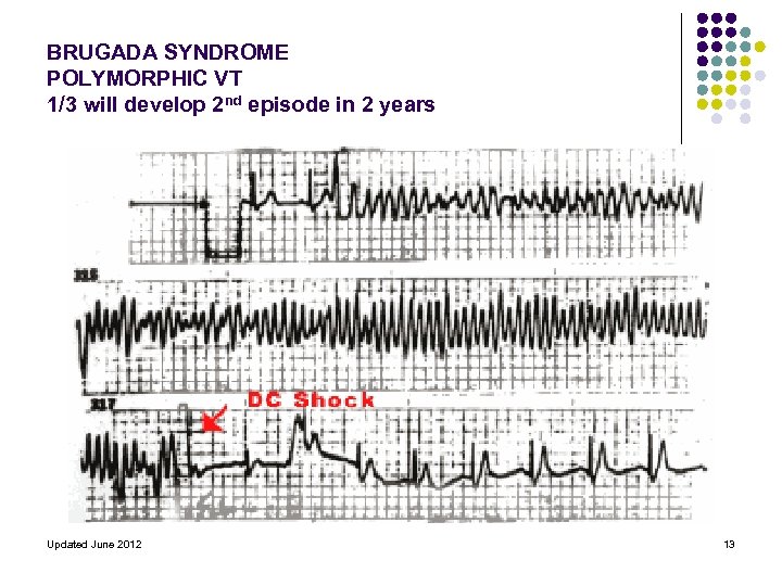 BRUGADA SYNDROME POLYMORPHIC VT 1/3 will develop 2 nd episode in 2 years Updated