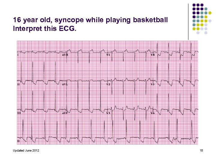 16 year old, syncope while playing basketball Interpret this ECG. Updated June 2012 15