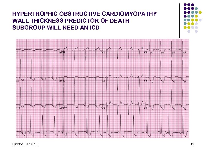 HYPERTROPHIC OBSTRUCTIVE CARDIOMYOPATHY WALL THICKNESS PREDICTOR OF DEATH SUBGROUP WILL NEED AN ICD Updated