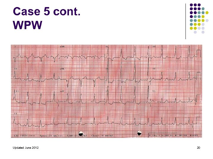 Case 5 cont. WPW Updated June 2012 20 