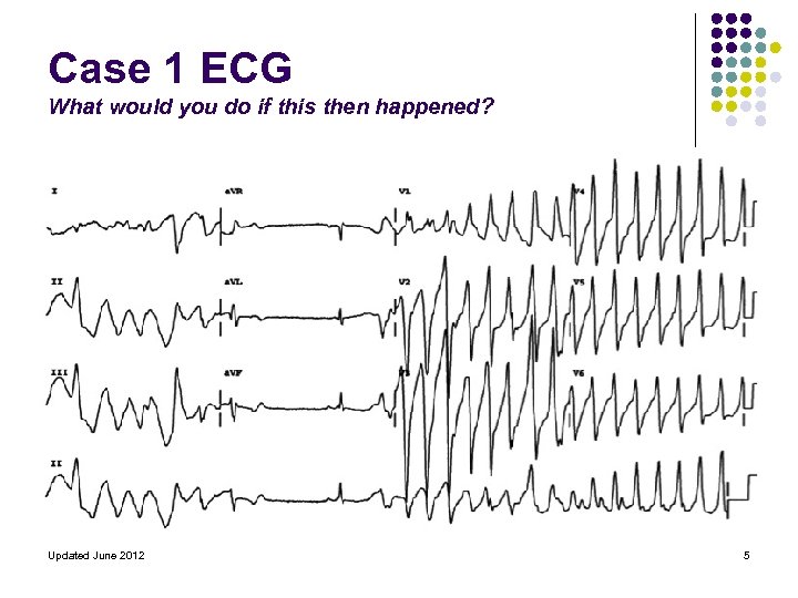 Case 1 ECG What would you do if this then happened? Updated June 2012