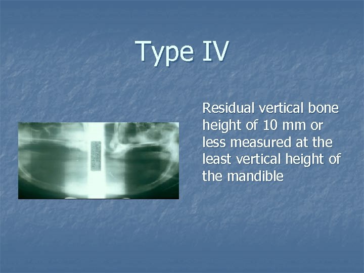 Type IV Residual vertical bone height of 10 mm or less measured at the