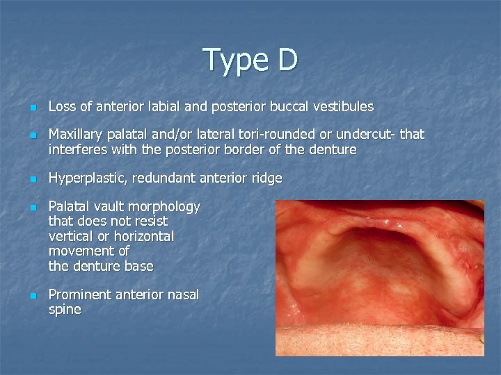 Type D n n n Loss of anterior labial and posterior buccal vestibules Maxillary