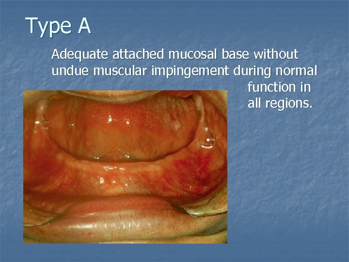 Type A Adequate attached mucosal base without undue muscular impingement during normal function in