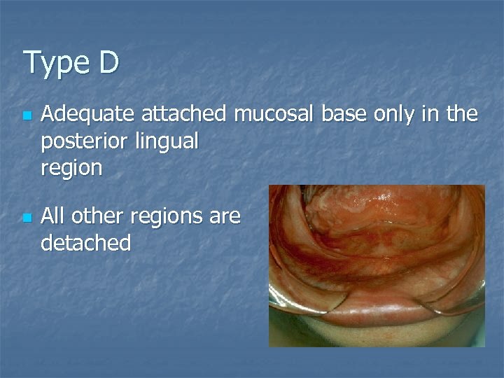 Type D n n Adequate attached mucosal base only in the posterior lingual region