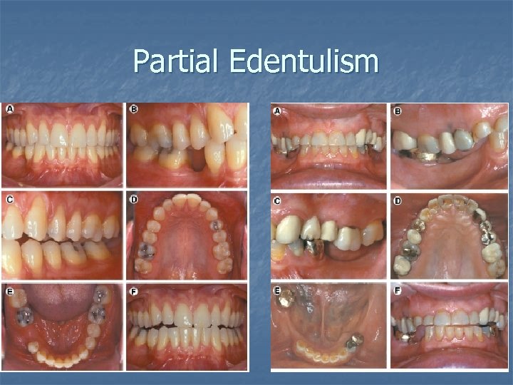 Partial Edentulism 