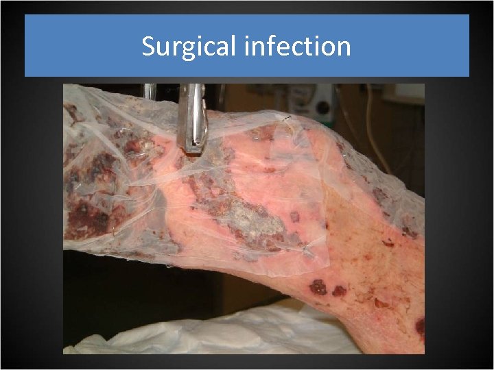 Surgical infection 