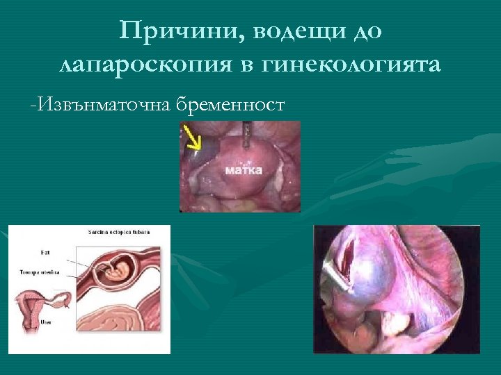 Причини, водещи до лапароскопия в гинекологията -Извънматочна бременност 