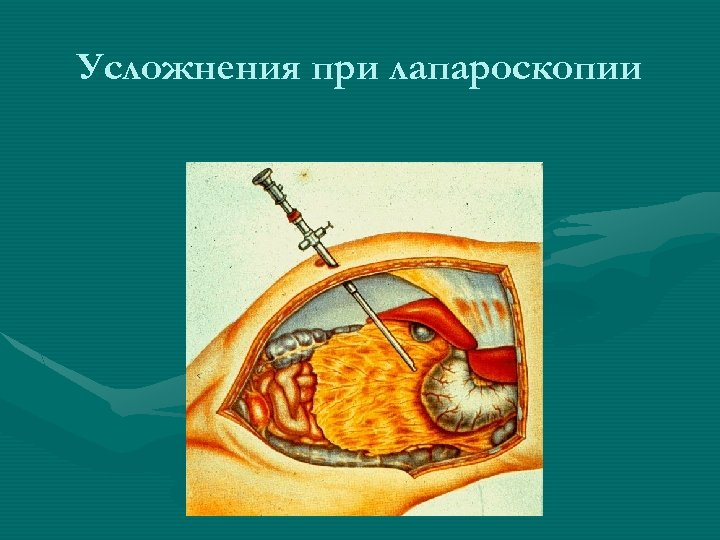 Усложнения при лапароскопии 