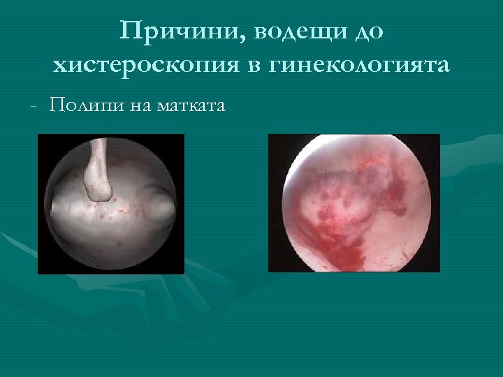 Причини, водещи до хистероскопия в гинекологията - Полипи на матката 
