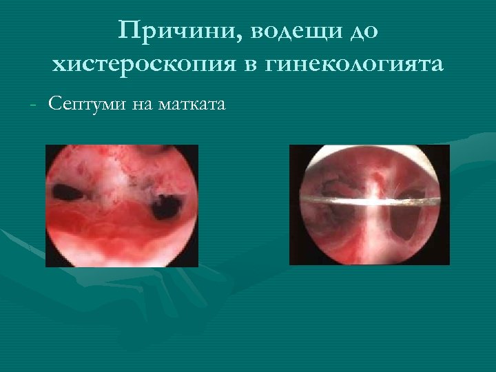 Причини, водещи до хистероскопия в гинекологията - Септуми на матката 