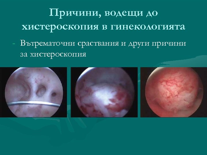 Причини, водещи до хистероскопия в гинекологията - Вътрематочни сраствания и други причини за хистероскопия