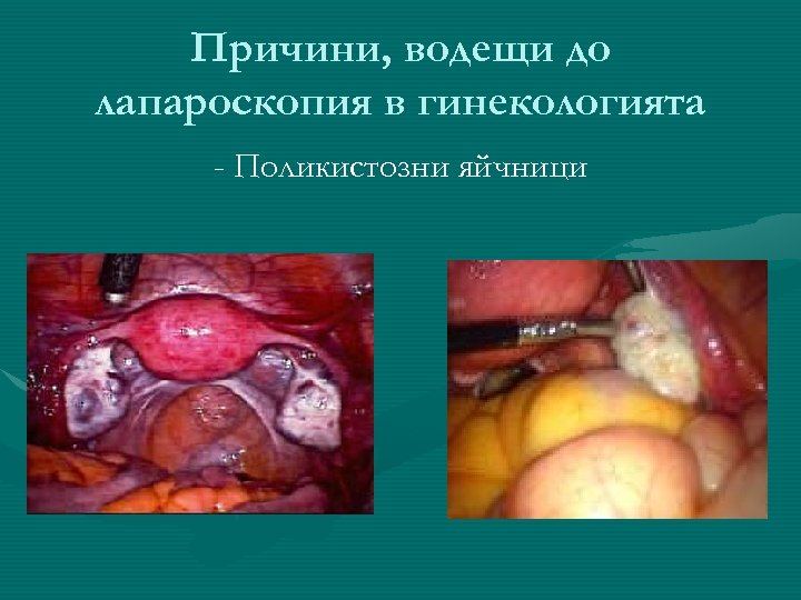Причини, водещи до лапароскопия в гинекологията - Поликистозни яйчници 