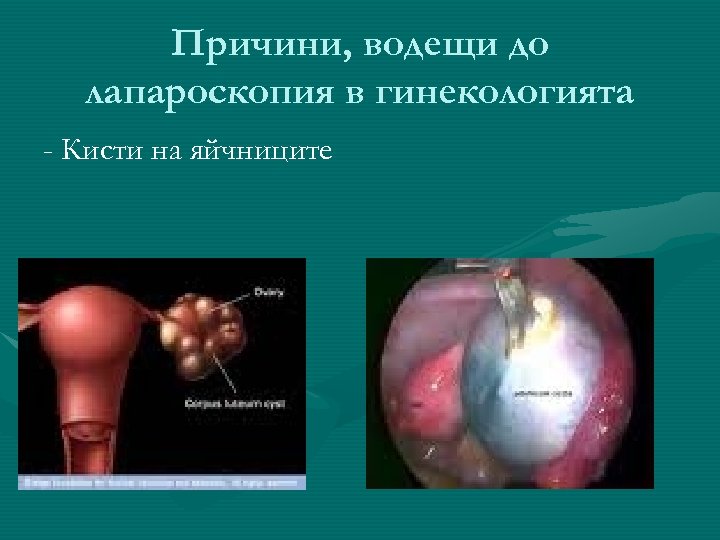 Причини, водещи до лапароскопия в гинекологията - Кисти на яйчниците 