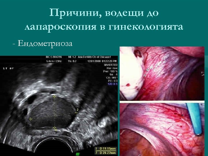 Причини, водещи до лапароскопия в гинекологията - Ендометриоза 