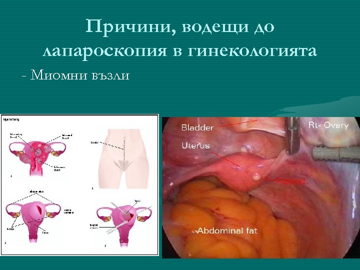 Причини, водещи до лапароскопия в гинекологията - Миомни възли 