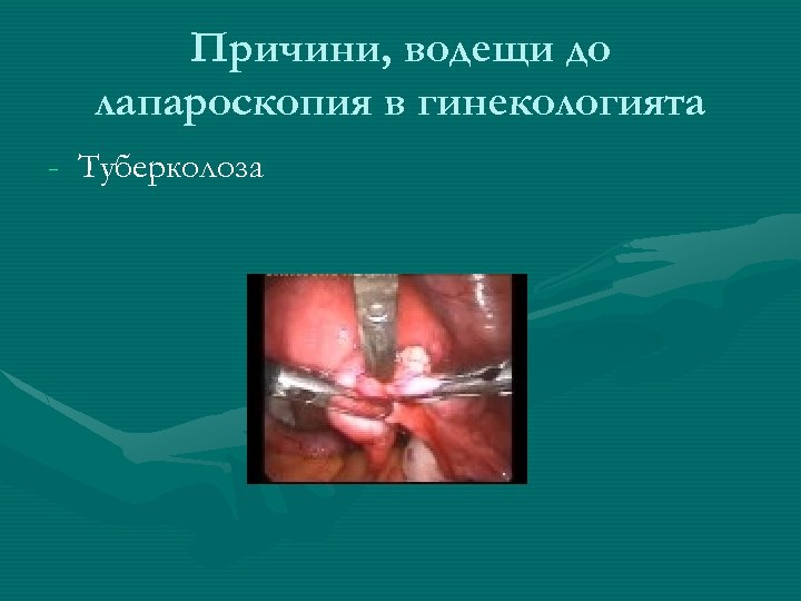 Причини, водещи до лапароскопия в гинекологията - Туберколоза 