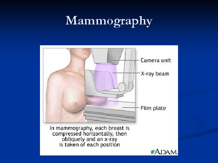 Mammography 