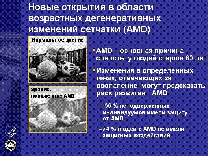 Новые открытия в области возрастных дегенеративных изменений сетчатки (AMD) Нормальное зрение § AMD –