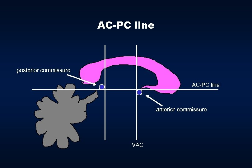 AC-PC line posterior commissure AC-PC line anterior commissure VAC 