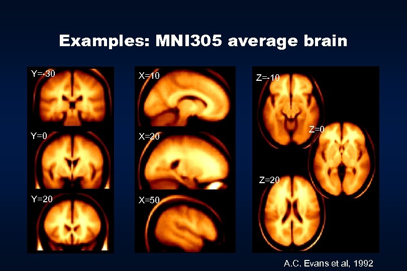 Examples: MNI 305 average brain Y=-30 X=10 Y=0 X=20 Z=-10 Z=20 Y=20 X=50 A.