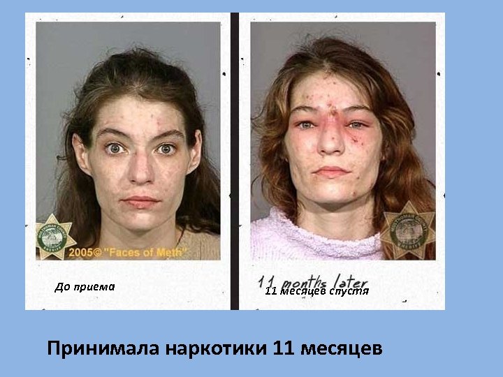 До приема 11 месяцев спустя Принимала наркотики 11 месяцев 