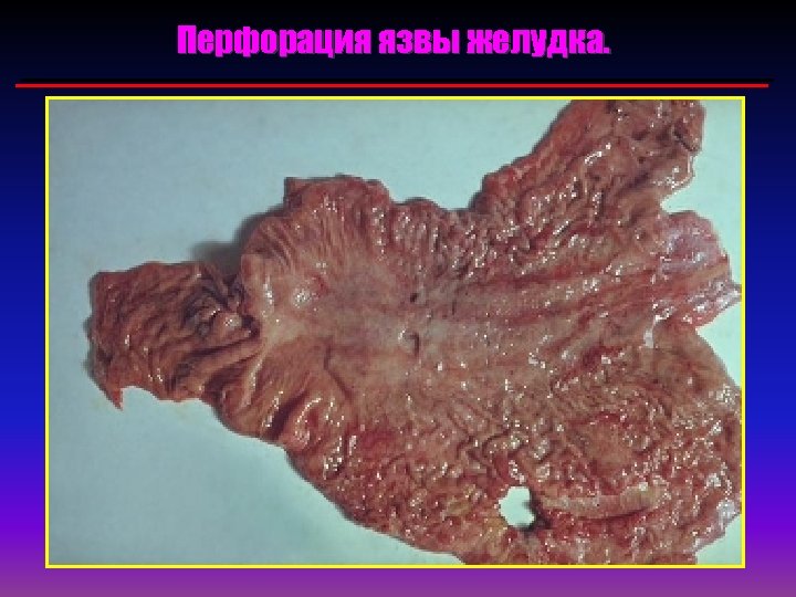 Перфорация язвы желудка. 