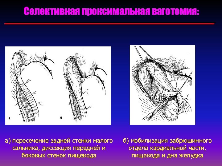 Удаление малого сальника