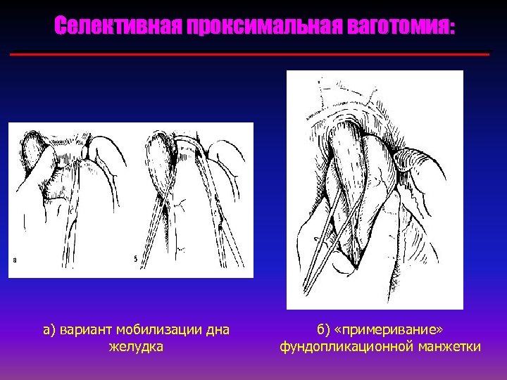 Селективная проксимальная ваготомия: а) вариант мобилизации дна желудка б) «примеривание» фундопликационной манжетки 