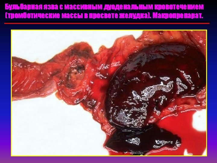 Бульбарная язва с массивным дуоденальным кровотечением (тромботические массы в просвете желудка). Макропрепарат. 