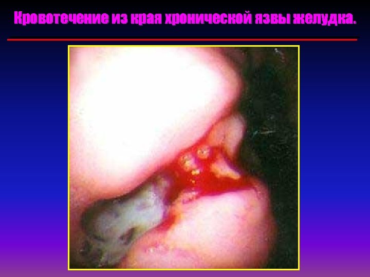 Кровотечение из края хронической язвы желудка. 
