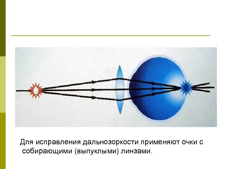 Для исправления дальнозоркости применяют очки с собирающими (выпуклыми) линзами. 