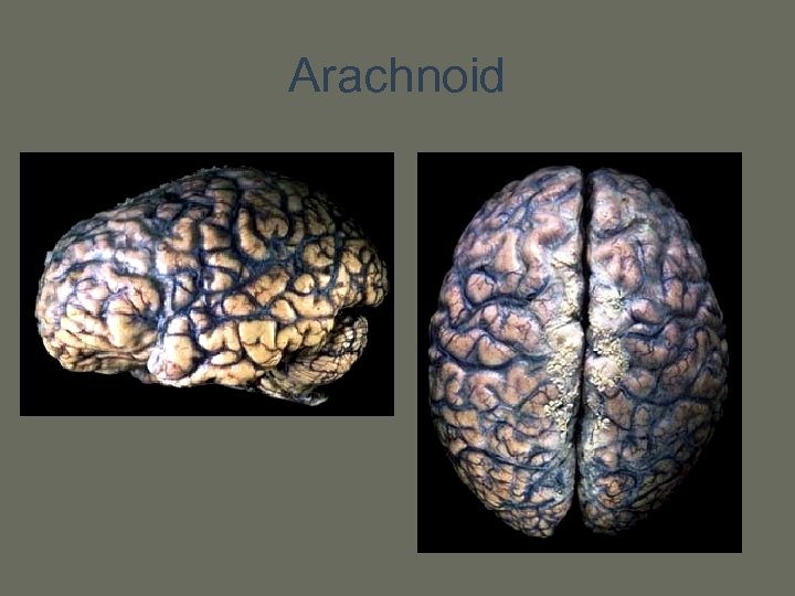 Arachnoid 