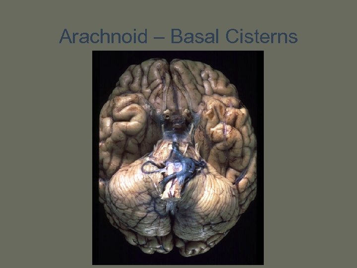 Arachnoid – Basal Cisterns 