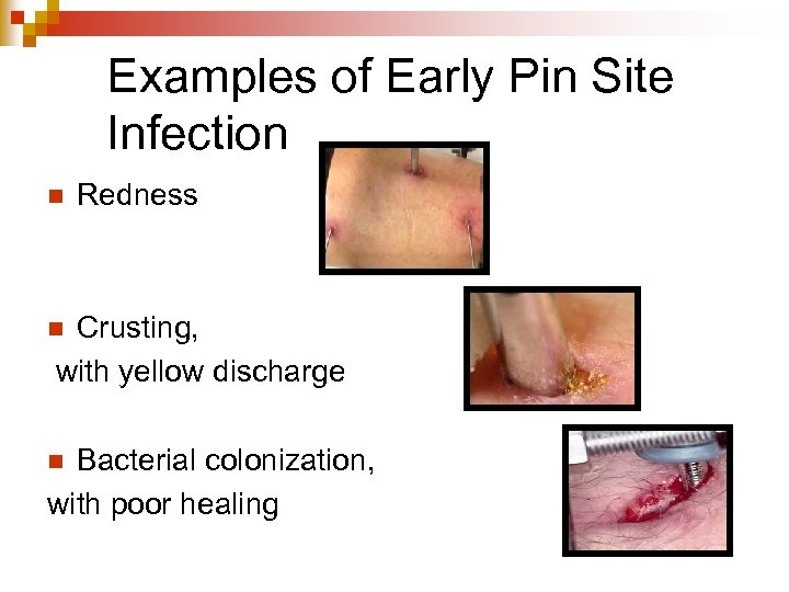Examples of Early Pin Site Infection n Redness Crusting, with yellow discharge n Bacterial